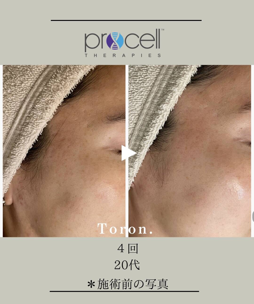 procellフェイシャル | Toron.